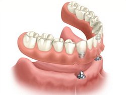 implant Dentures