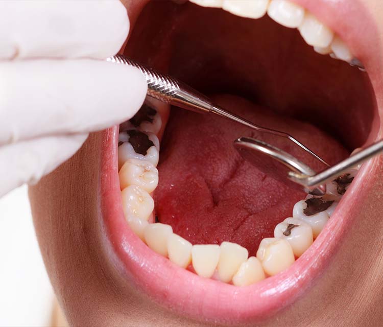 Diş Çürüğü Nedir? Tedavisi Nasıl Yapılır?