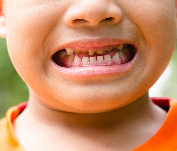 Çocuklarda ve Yetişkinlerde Diş Kırıklarının Tedavisi